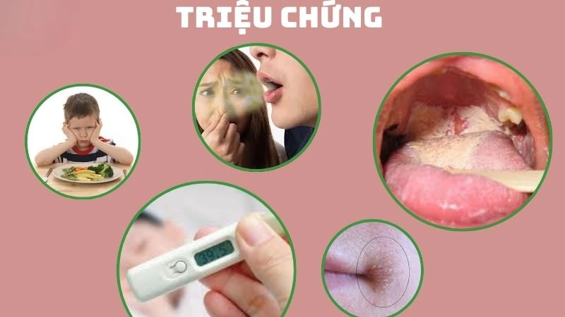Triệu chứng khi bị nấm candida phổ biến
