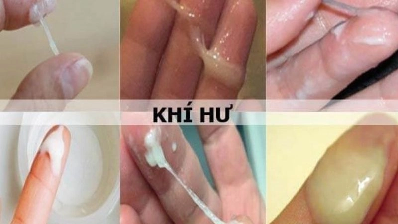 Khí hư còn được gọi là dịch tiết âm đạo hay huyết trắng 
