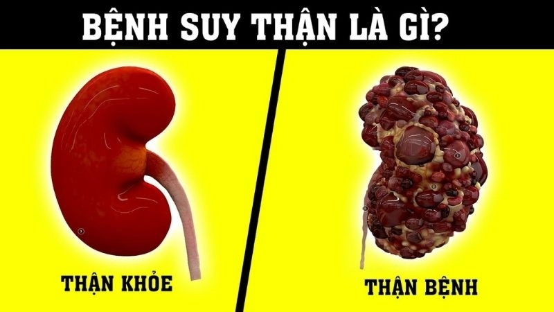 Suy thận là tình trạng thận không còn hoạt động hiệu quả nữa