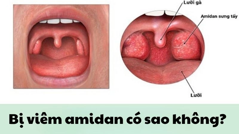 Bị viêm amidan có sao không và khi nào cần cắt bỏ gấp