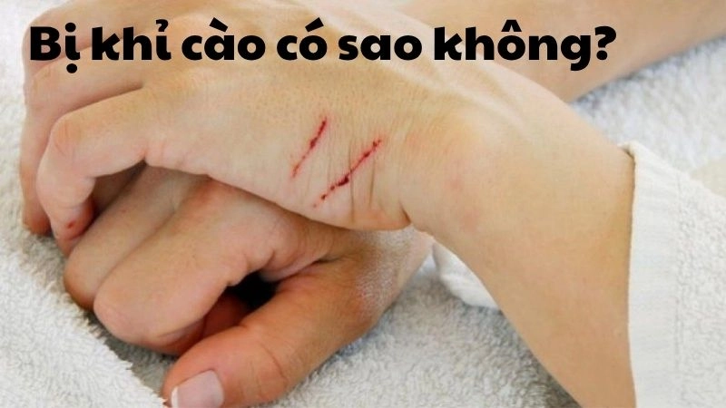 Bị khỉ cào có sao không và các bệnh lý cần lưu ý ngay