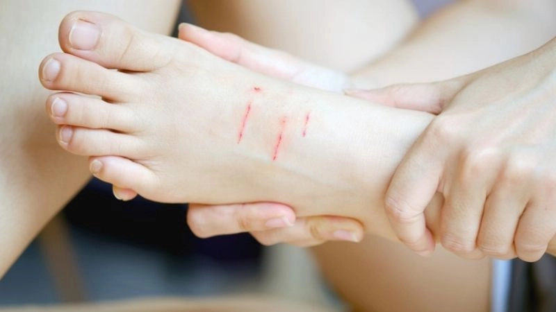 Bị khỉ cào có sao không còn tùy thuộc vào phản ứng ban đầu của cơ thể