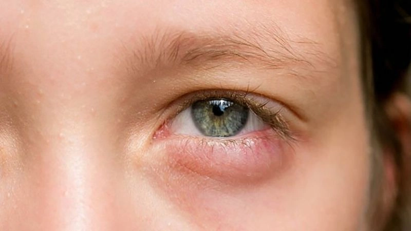 Triệu chứng khi bị ngứa mắt không nên bỏ qua