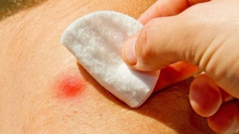 Triệu chứng khi bị ruồi trâu cắn thường gặp