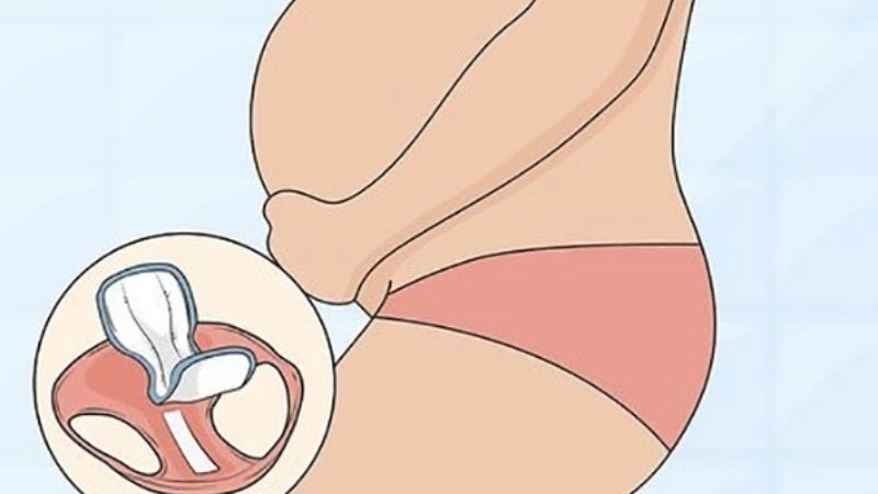 Làm gì khi bị rỉ ối để tránh biến chứng nguy hiểm