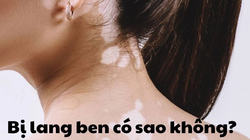 Bị lang ben có sao không và những hậu quả âm thầm