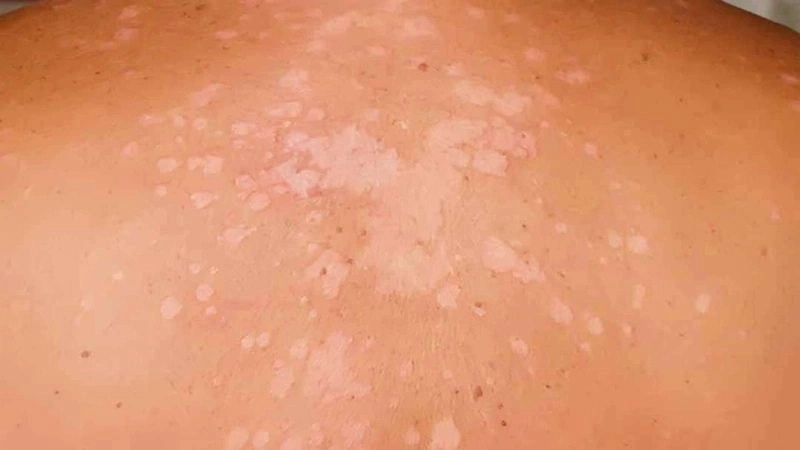 Hành động cần thiết khi phát hiện lang ben