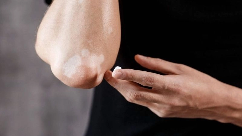 Biện pháp cải thiện và điều trị lang ben an toàn