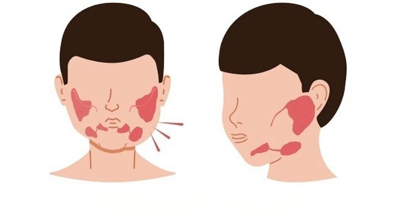 Nguyên nhân dẫn đến tái phát quai bị lần hai