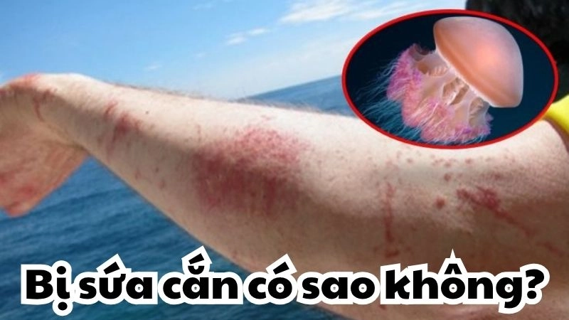 Bị sứa cắn có sao không và cách xử lý an toàn kịp thời