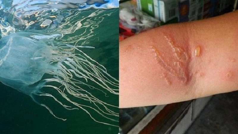 Triệu chứng sau khi bị sứa cắn thường gặp