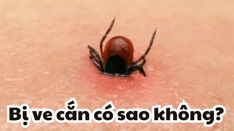 Bị ve cắn có sao không và các bước xử lý khẩn cấp an toàn