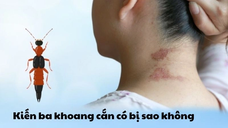 Kiến ba khoang cắn có bị sao không và cách phòng ngừa