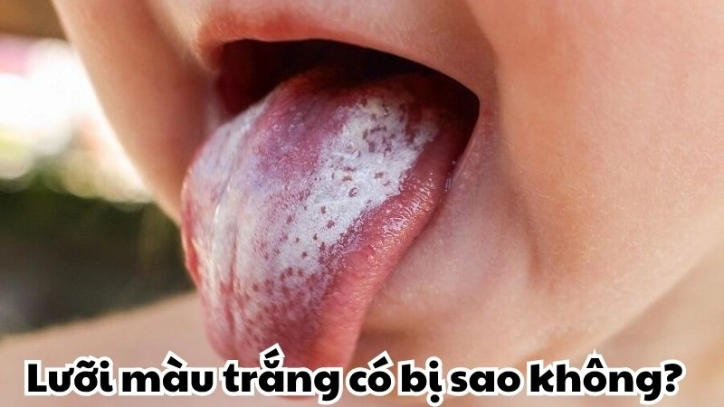 Lưỡi màu trắng có bị sao không và khi nào cần đi khám