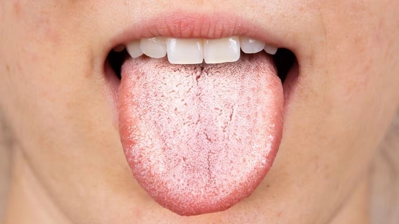 Làm gì ngay khi phát hiện lưỡi màu trắng