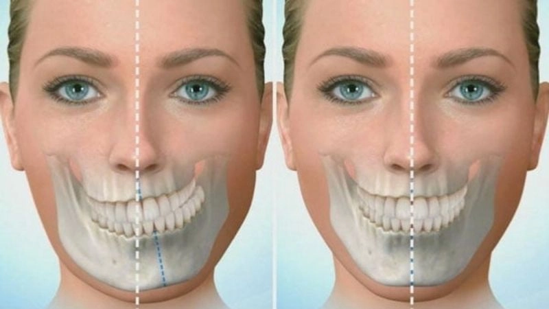 Người bị khớp cắn lệch cũng chính là những trường hợp hàm bị lệch