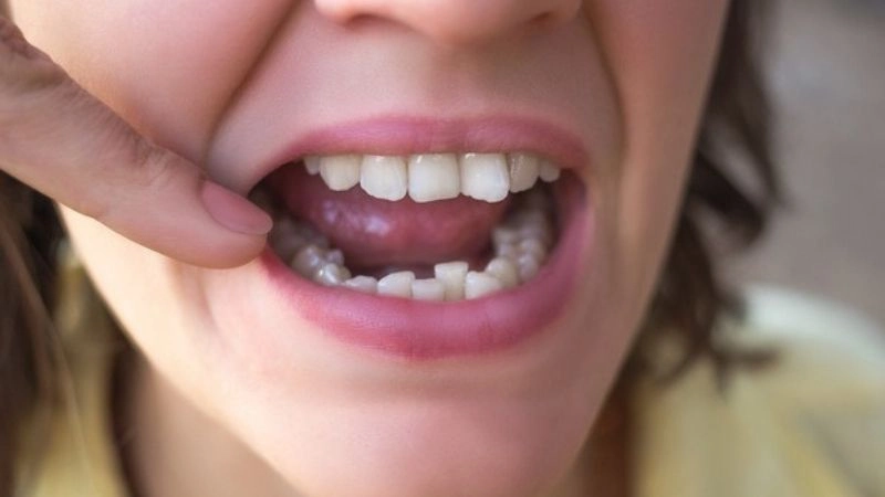 Hàm bị lệch có thể do nhiều nguyên nhân khách quan và chủ quan