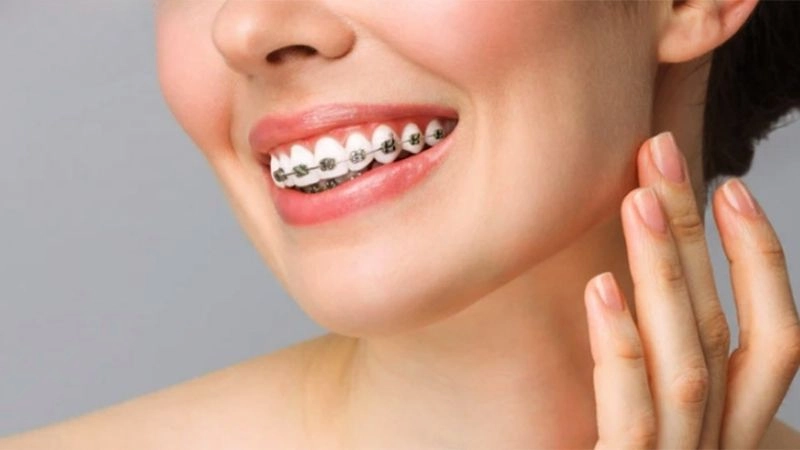 Phương pháp niềng răng khắc phục hàm lệch