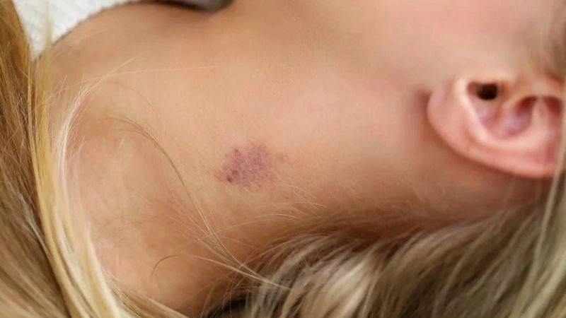 Cần làm gì khi bị người yêu cắn