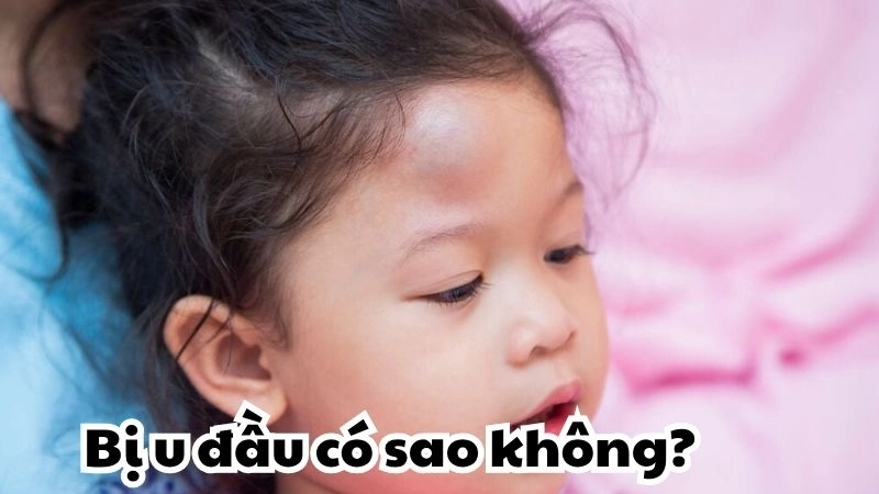 Bị u đầu có sao không và làm thế nào để giảm đau hiệu quả