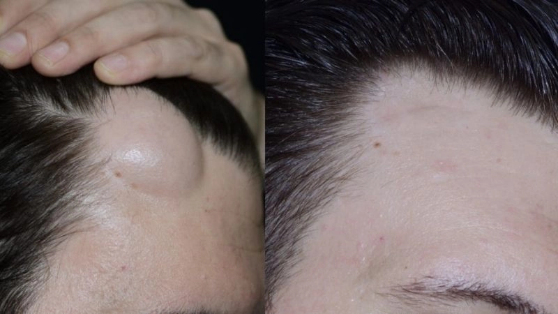 Bị u đầu có thể là bình thường hoặc nghiêm trọng, tùy thuộc vào nguyên nhân