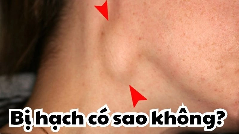 Bị hạch có sao không - Dấu hiệu cảnh báo bệnh lý nguy hiểm