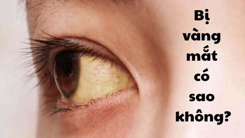 Bị vàng mắt có sao không và cách khắc phục nhanh chóng