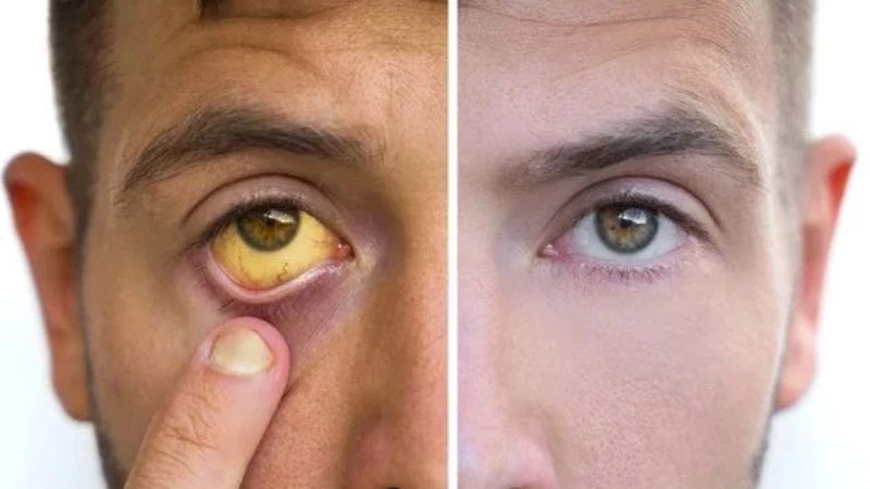 Mắt vàng thường là do các bệnh liên quan đến gan gây nên
