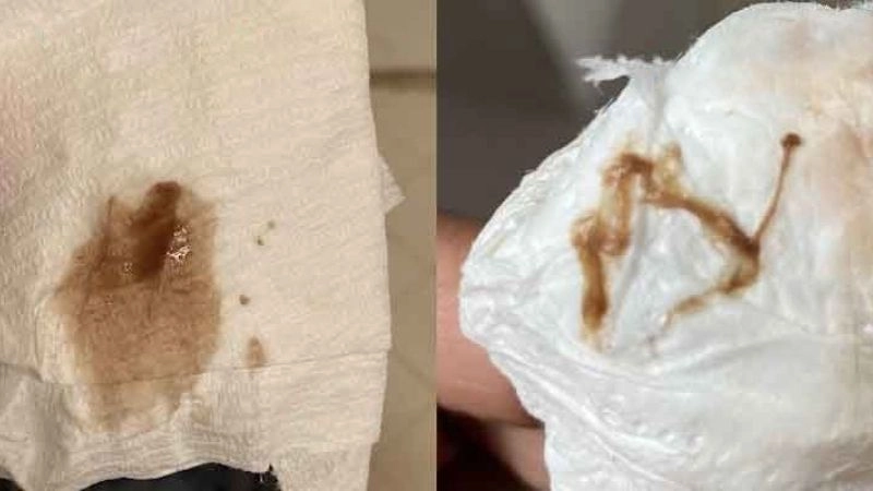 Làm gì khi bị dịch màu nâu kéo dài