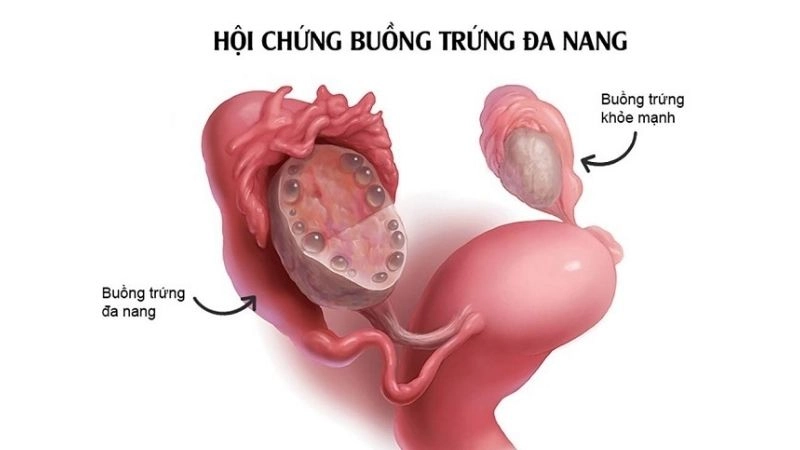 Nguyên nhân dẫn đến dịch màu nâu thường gặp