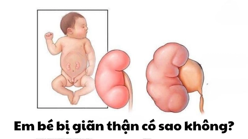 Em bé bị giãn thận có sao không - Cha mẹ cần làm gì ngay