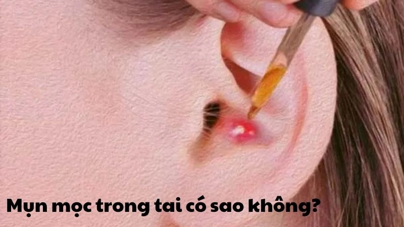 Mụn mọc trong tai có bị sao không cần lưu ý những gì
