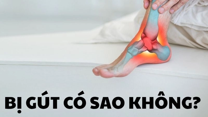 Bị gút có sao không và cách xử lý khi cơn đau ập đến