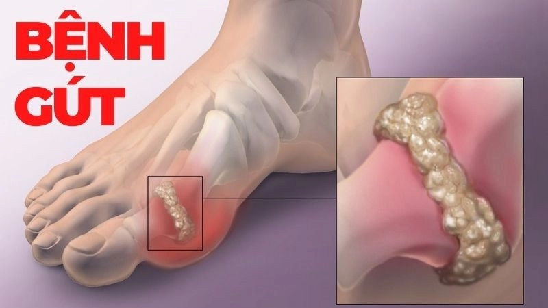 Bệnh gút (còn gọi là gout hay thống phong) là một dạng viêm khớp phổ biến