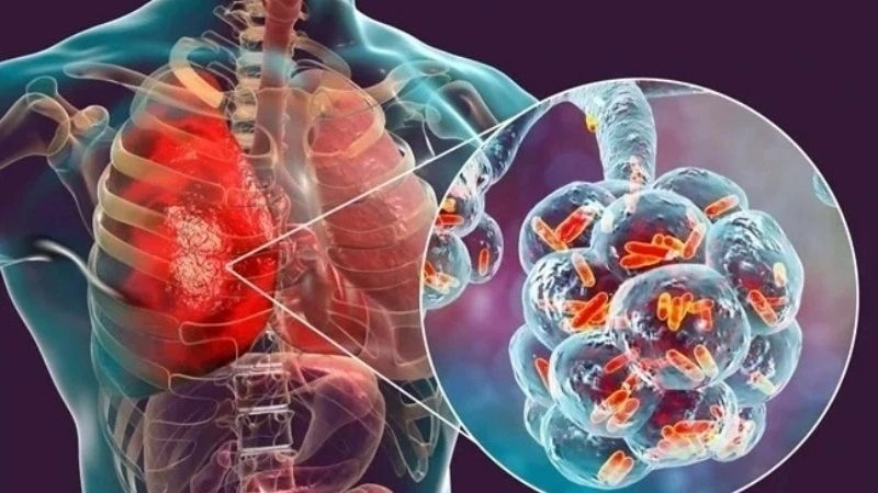 Nguyên nhân khiến bạn mắc bệnh lao phổi