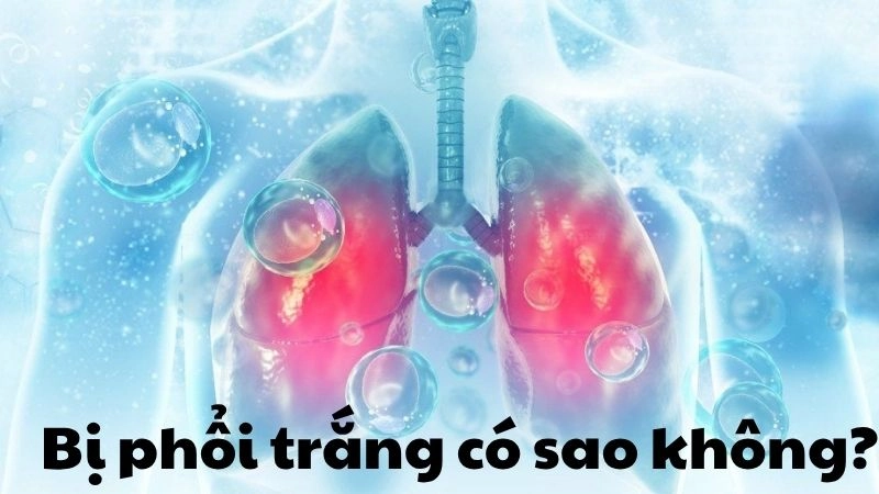 Bị phổi trắng có sao không và mức độ nguy hiểm thực sự