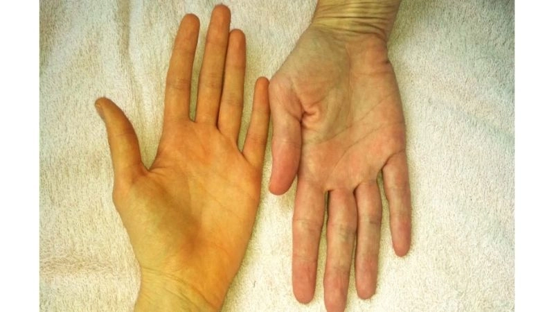 Vàng da nên quan sát dưới ánh sáng mặt trời và quan sát ở vùng da được che kín