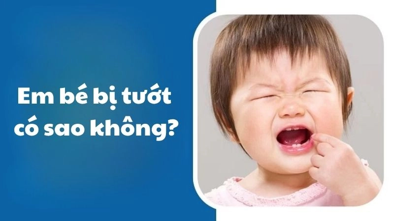 Em bé bị tướt có sao không khi trẻ bước vào tuổi mọc răng