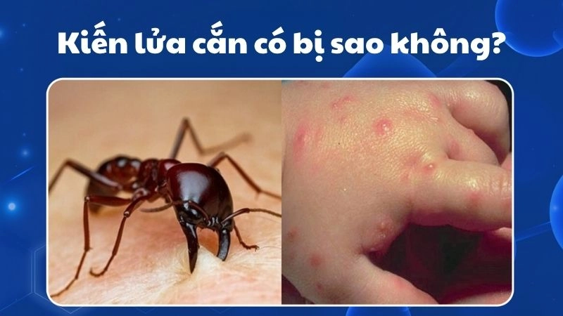 Kiến lửa cắn có bị sao không và cách xử lý tại nhà
