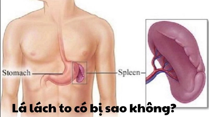Lá lách to có bị sao không? Nguyên nhân và cách xử lý