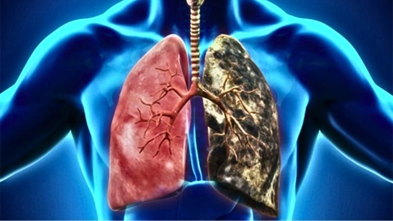 Người bệnh xơ phổi thường bị khó thở (đặc biệt là khi vận động)