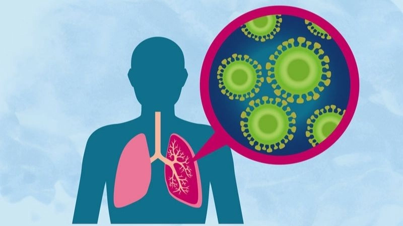 Viêm phổi là tình trạng viêm ở một hoặc vài vùng trong phổi