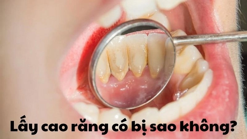 Lấy cao răng có bị sao không và sự thật nhiều người bỏ qua