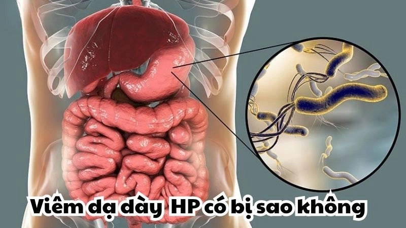 Viêm dạ dày HP có bị sao không và dấu hiệu cảnh báo