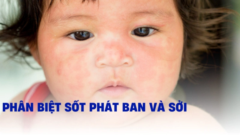 Cách phân biệt sởi và sốt phát ban chính xác ngay tại nhà