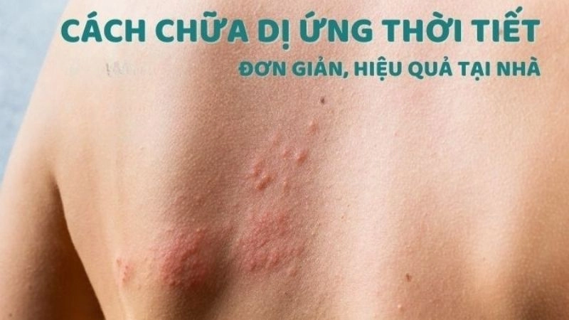 Bật mí mẹo dân gian chữa dị ứng thời tiết đơn giản tại nhà