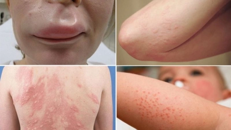 Mẹo dân gian chữa dị ứng thời tiết đơn giản dễ thực hiện