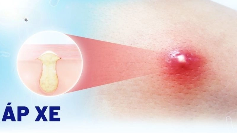 Bật mí mẹo dân gian trị áp xe an toàn và không đau đớn