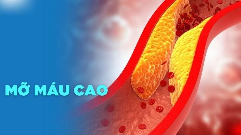 Máu nhiễm mỡ khiến các mảng mỡ bám vào thành động mạch