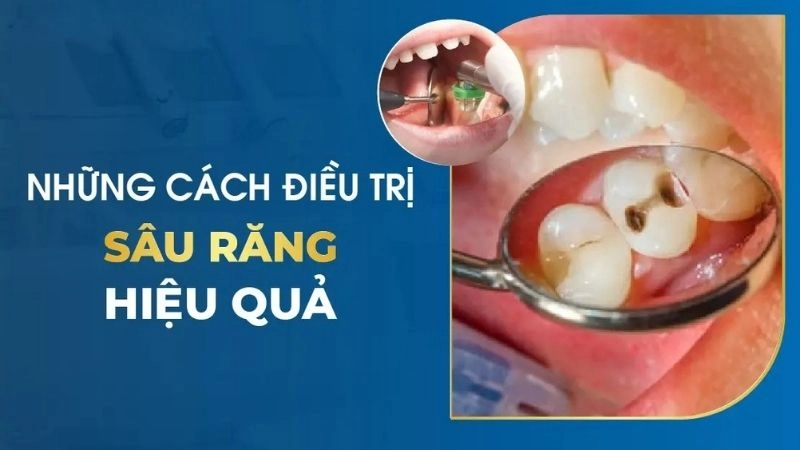 Trị dứt điểm sâu răng nhờ mẹo dân gian hiệu nghiệm